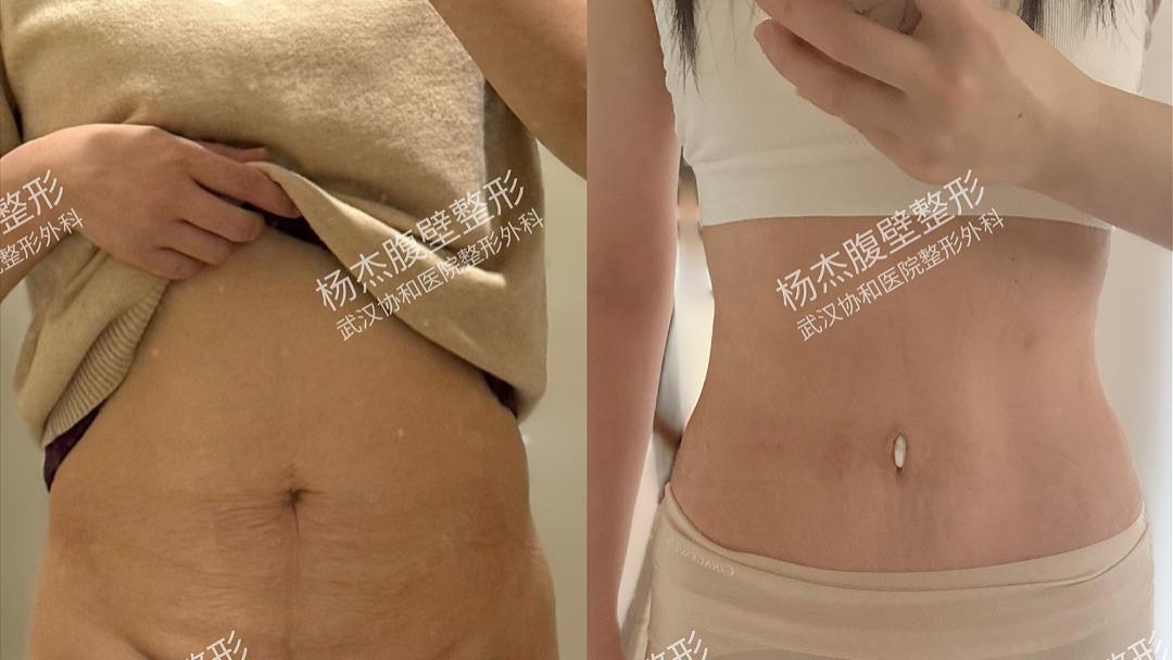腹壁整形=吸脂+去皮+缝肌肉？怪不得宝妈们说这是“产后换腰术”！