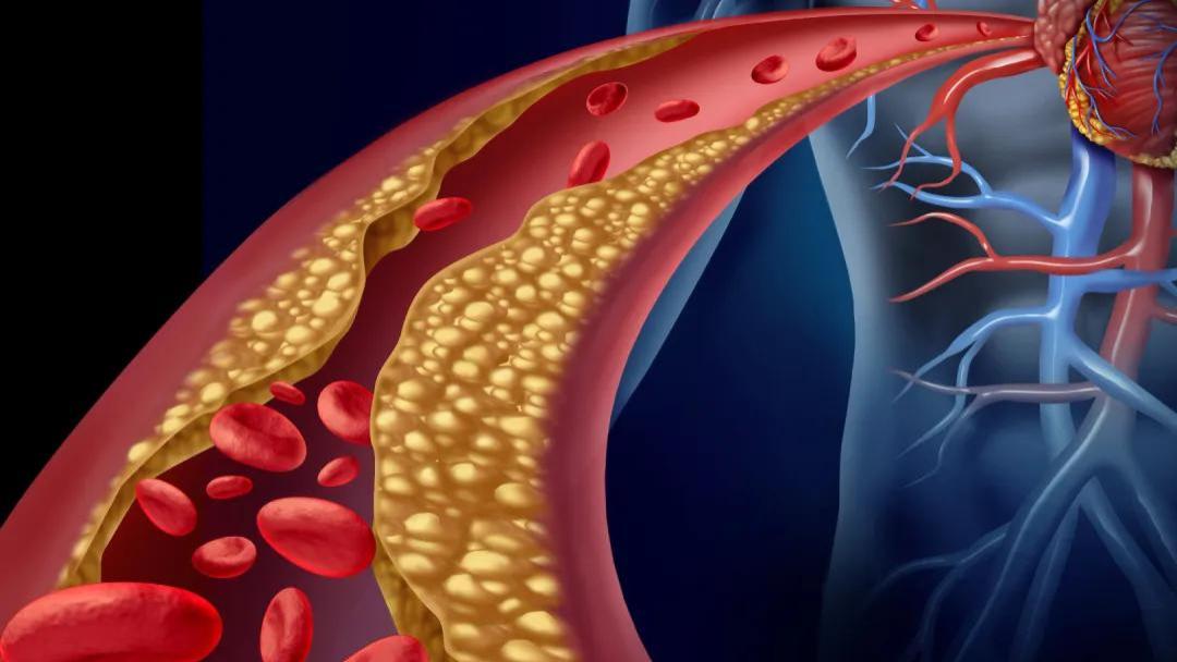 中国冠心病患者，炎症指标超出这个值，心血管风险增加50%！