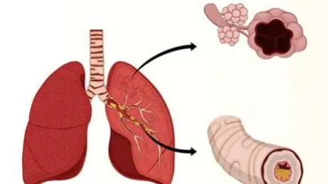 西医怎么治湿毒郁肺？不绕弯子，讲清原理和常用方法