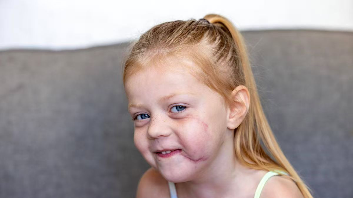 访友遇恶犬，四岁女童遭斗牛犬袭击，人生彻底被改写