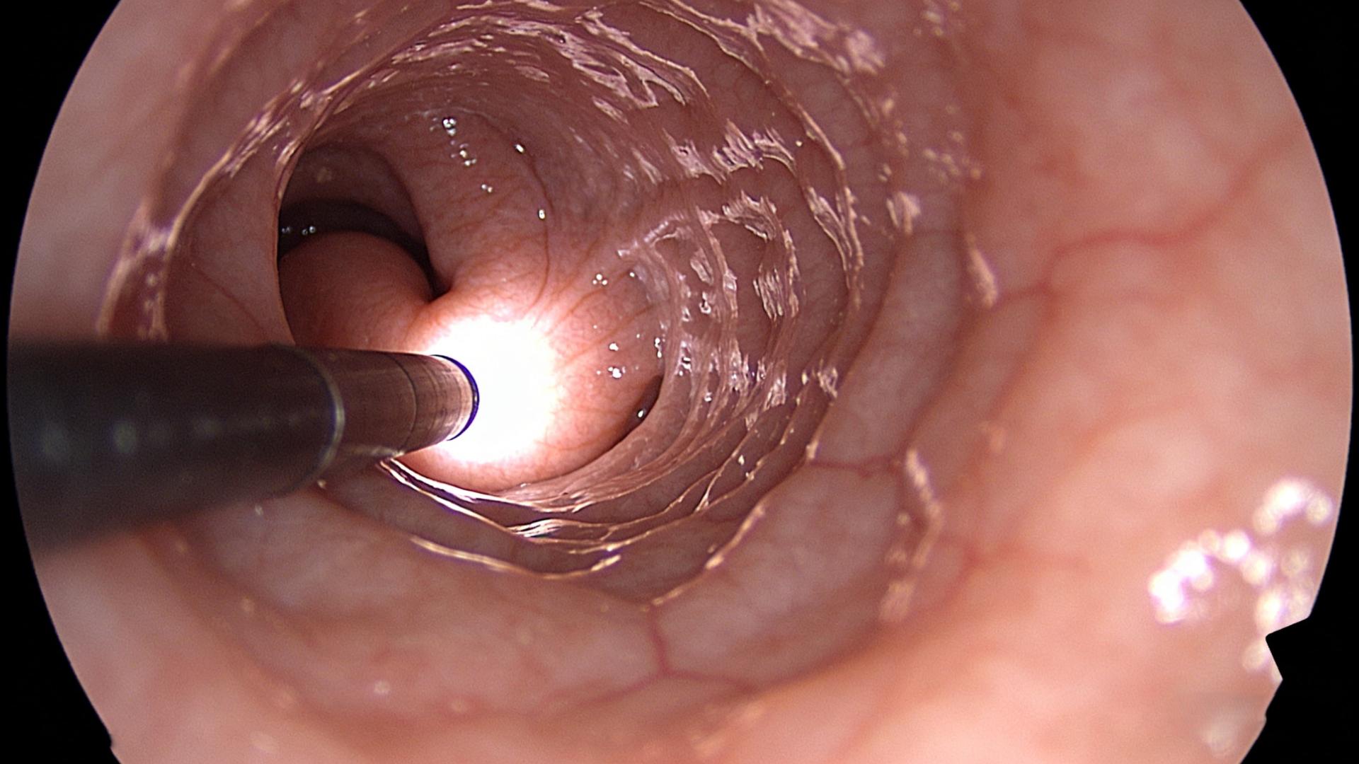 为什么胃镜有时会漏诊胃癌？我们又该如何应对？