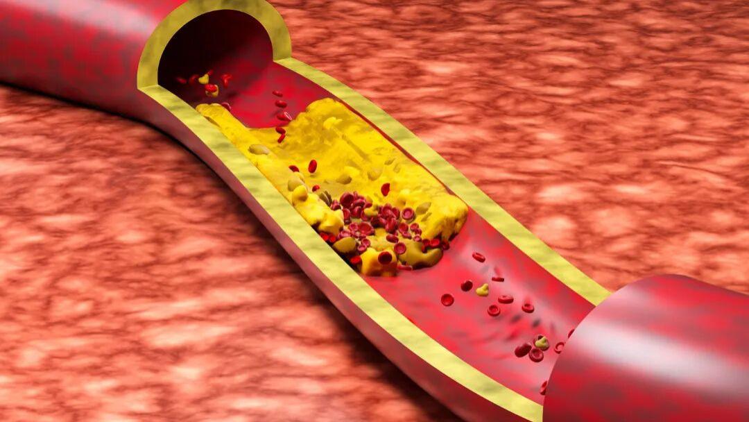 居家自测法，判断血管堵没堵