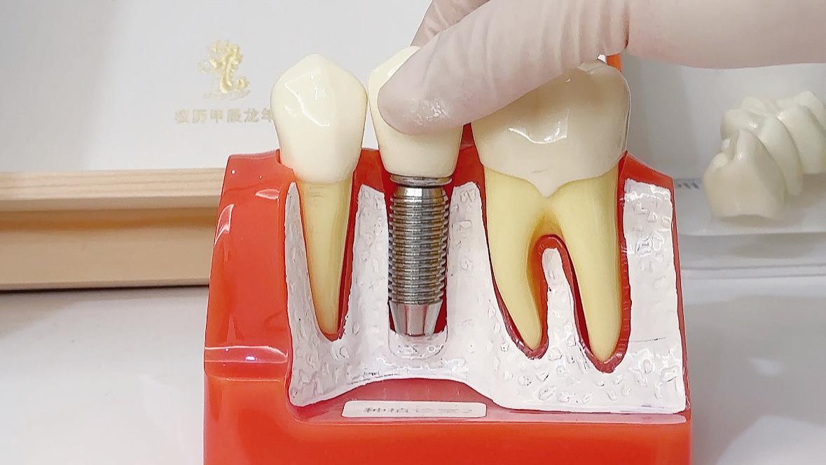 老年人种牙到底值不值？医生：先搞清楚这几个争议再决定