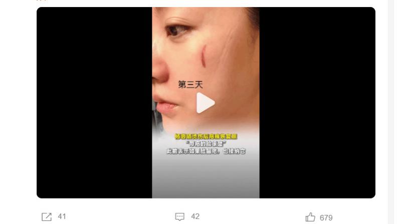 ​杨蓉晒烫伤后写真，称带疤的脸很酷，心态太绝了