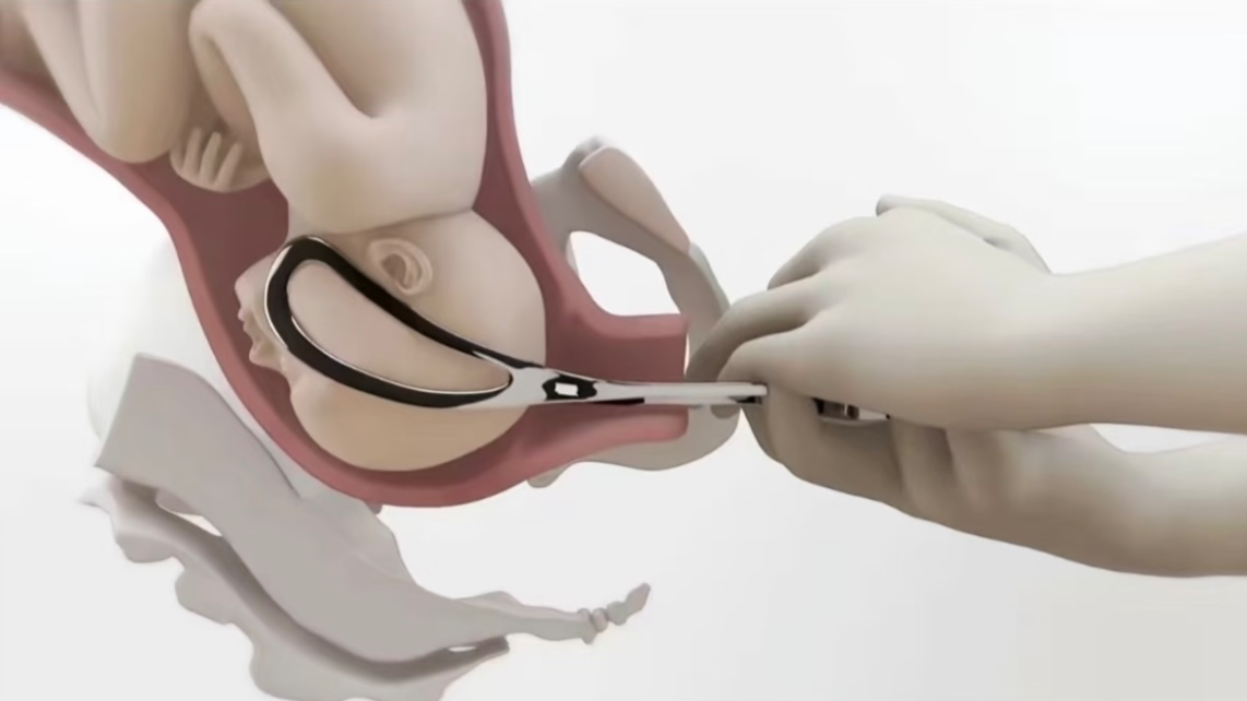 宝宝脸上的产钳印