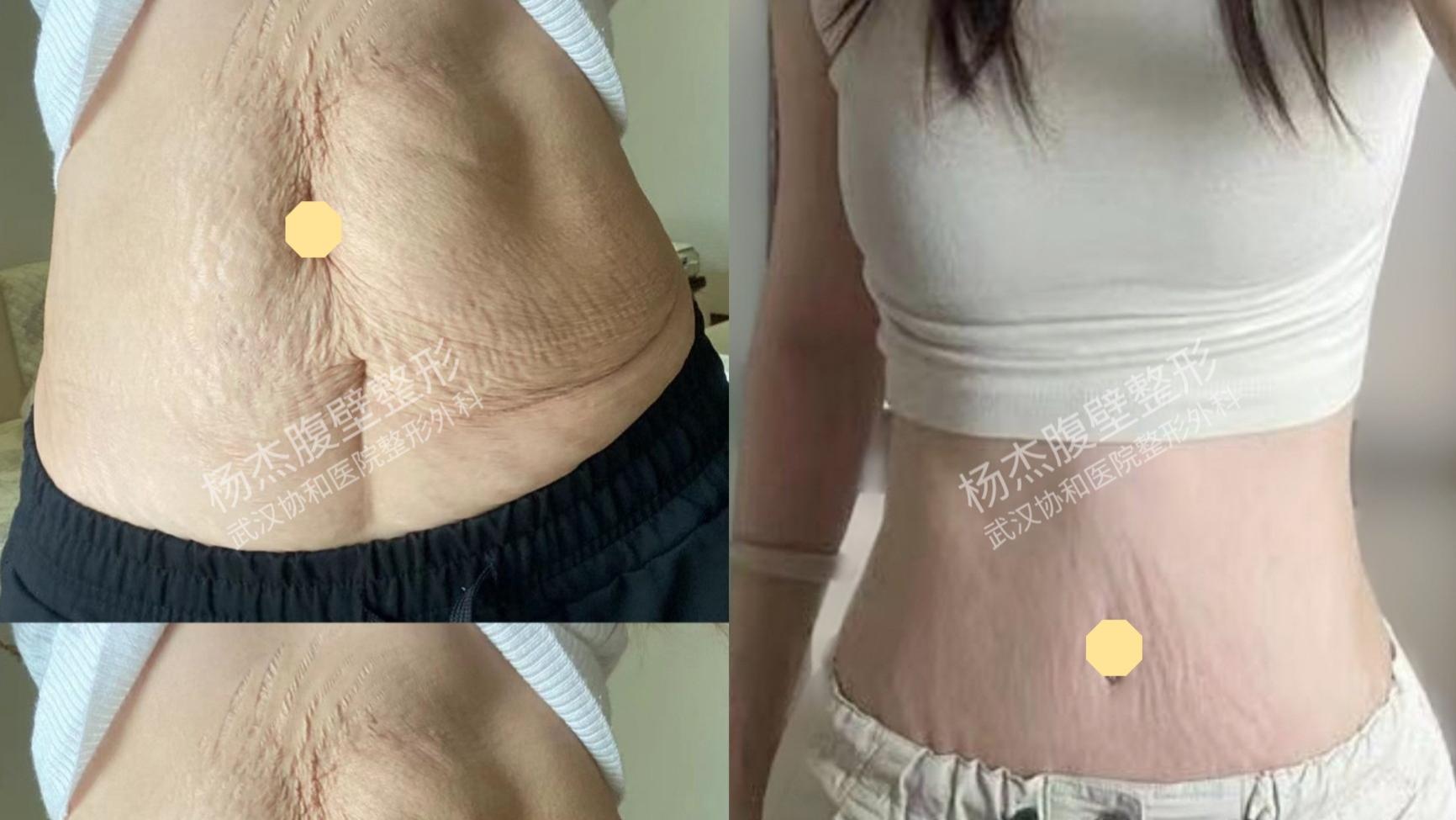 关于DFS腹壁成形术，这几点建议了解