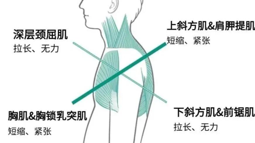 3 个 “老大肌群” 失衡惹的祸！交叉综合征的自查 + 治疗 + 康复指南