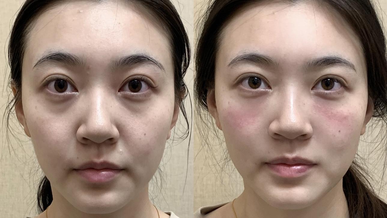 花4支捏的脸丨鼻基底丨苹果肌丨泪沟