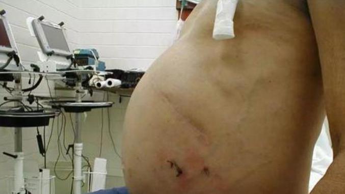 肝癌晚期“警报拉响”，中医视角为你拨云见日