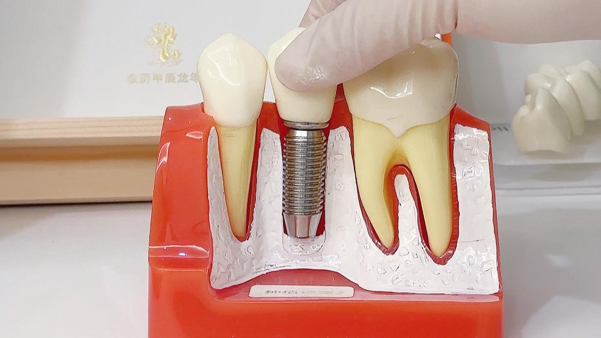 种牙前先看这篇：术后到底有多难受？医生把实话都告诉你