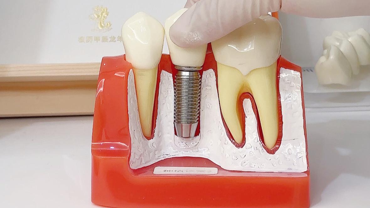 种牙到底痛不痛？