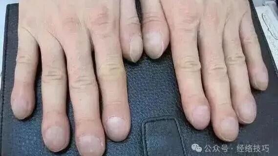手指出现这个变化，是身体在“求救”！杵状指的3个特征，40岁后别不当回事