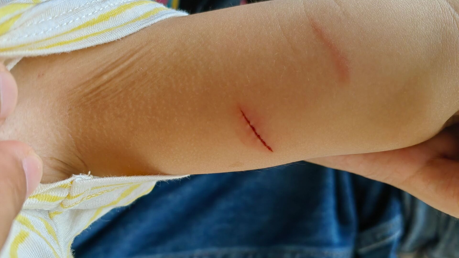 宝爸宝妈必知：宝宝小伤口紧急处理全攻略