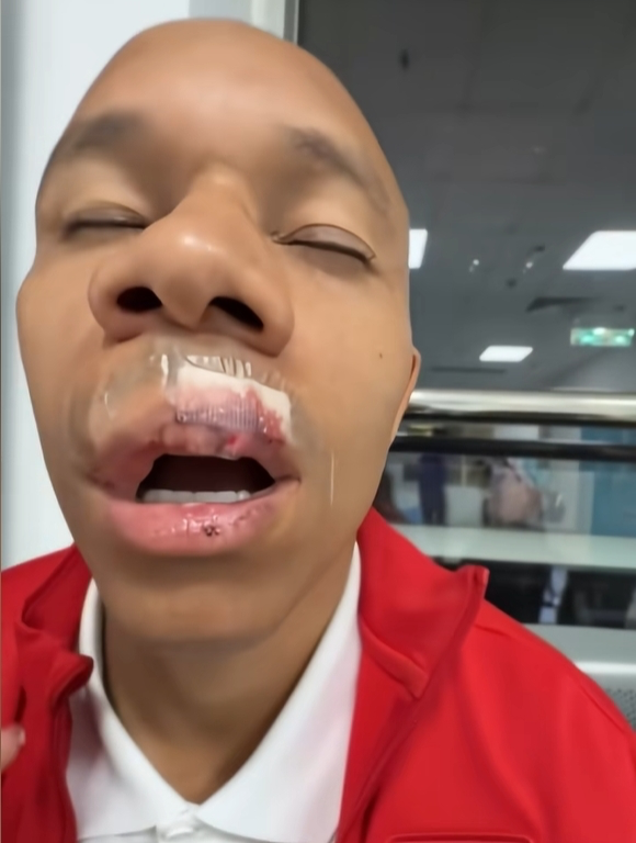 遭姜至鹏肘击！蓉城外援伤势严重：嘴唇缝15针+牙齿脱位，下轮