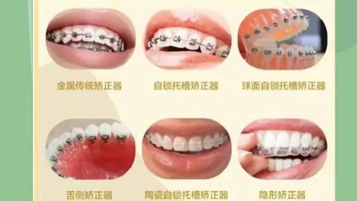 矫正牙齿为何这么贵？