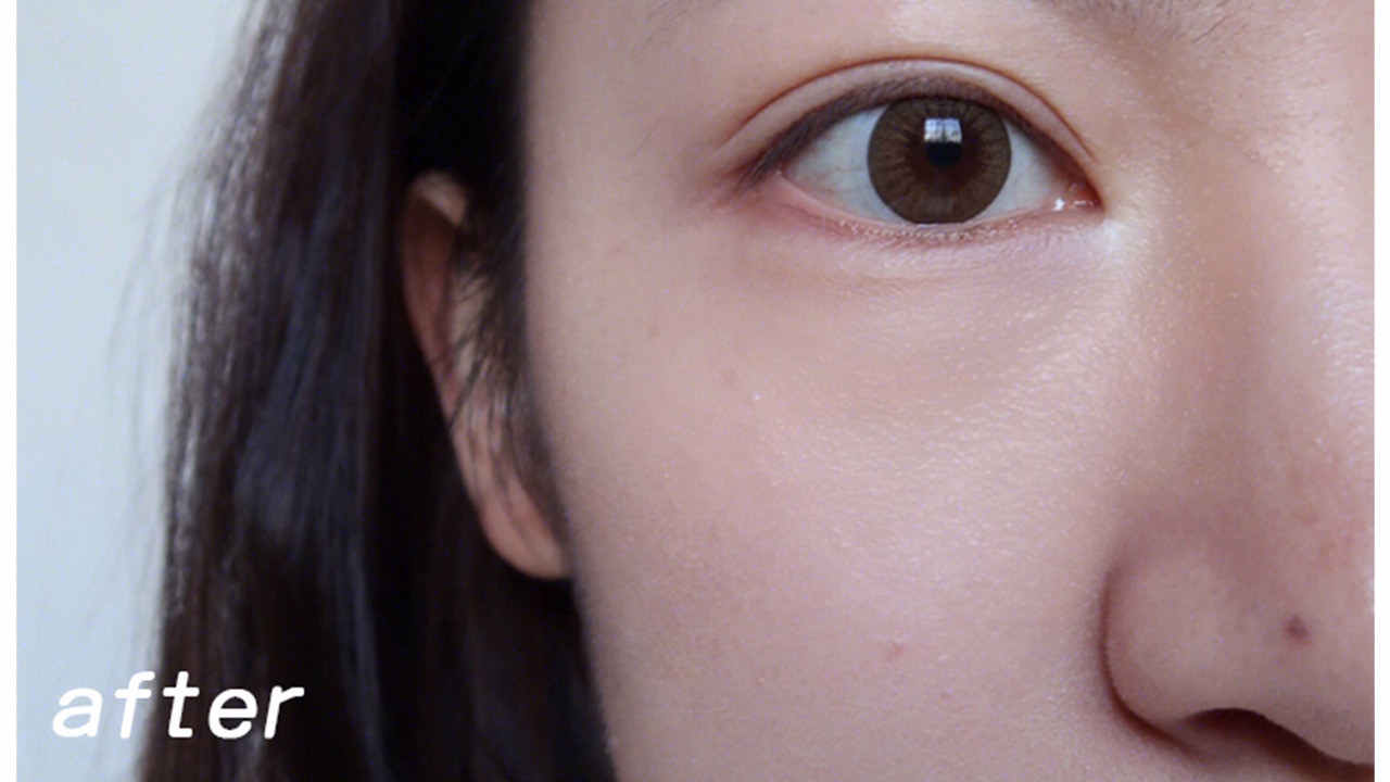 【谢杭峰又一力作】抬头纹/鱼尾纹解决方案｜非凡膜法，精准淡纹，重现平滑肌肤