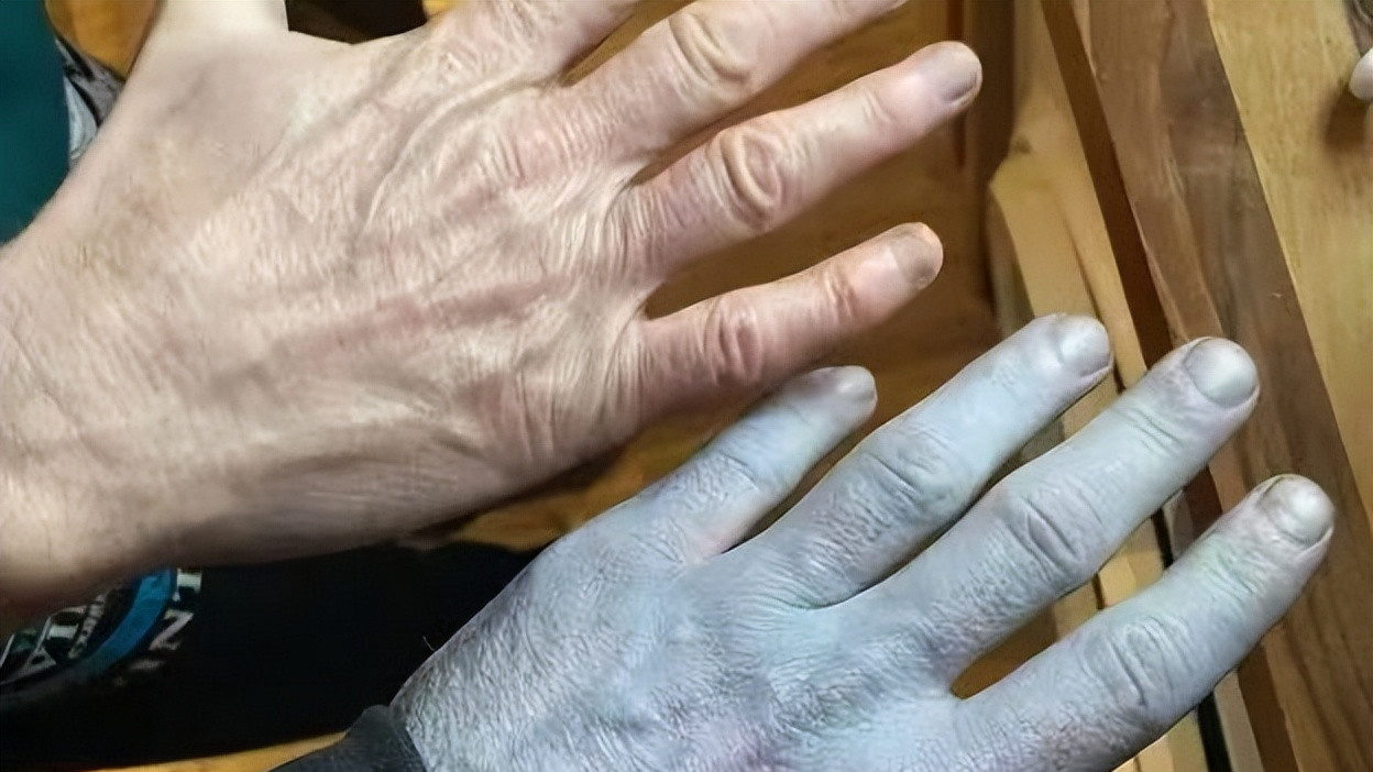 英男子睡醒浑身变蓝如阿凡达，急诊室全员紧张后集体笑喷