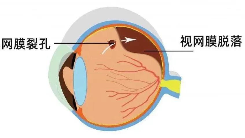 高度近视为什么容易视网膜脱落？