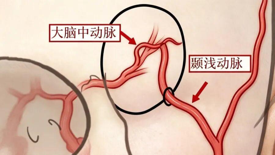 滨医附院神经外科成功开展脑动脉搭桥手术