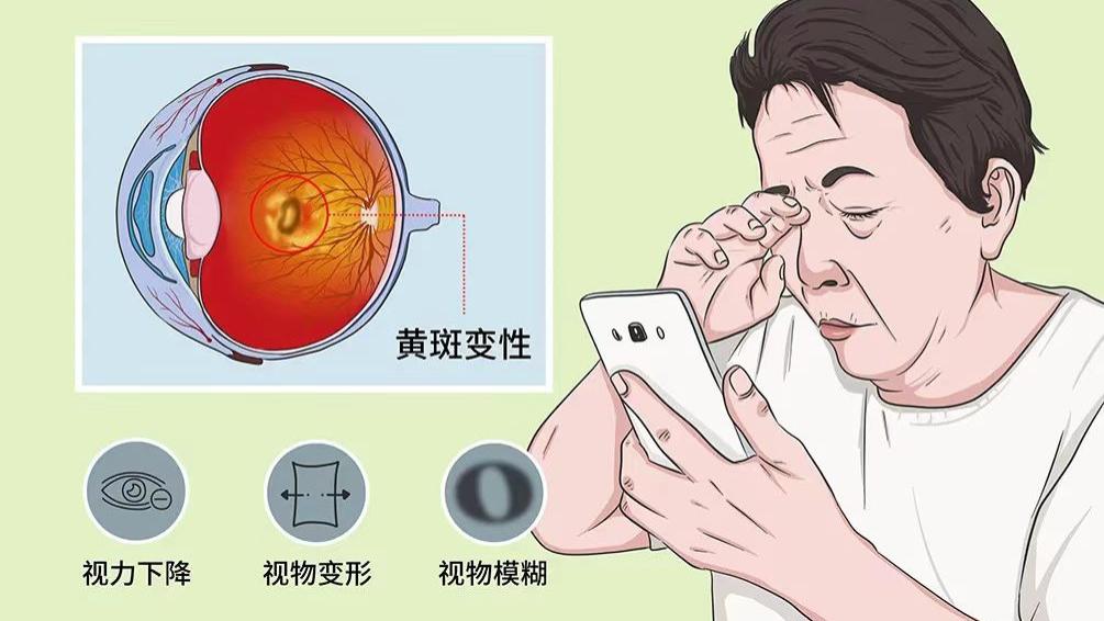 老是听说黄斑变性，到底什么是黄斑变性？