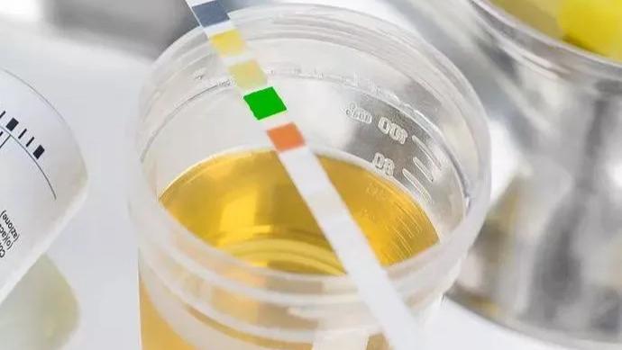 注意了！多年蛋白尿，记住这个范围！不超过，尿毒症就不会来