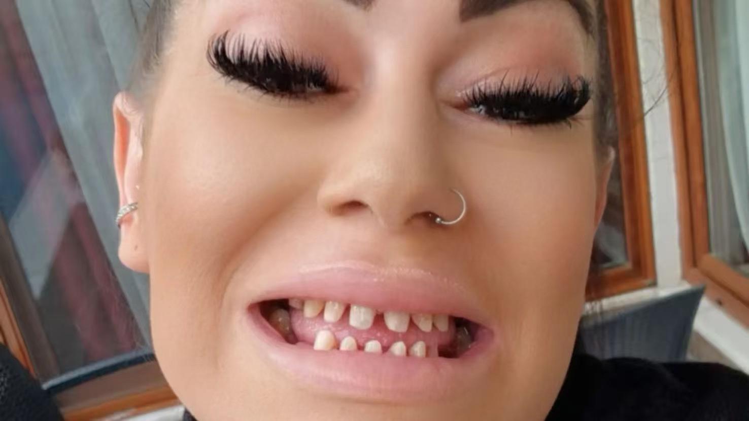 花16万整牙反失全部牙齿，英国妈妈跨国整牙变人生噩梦