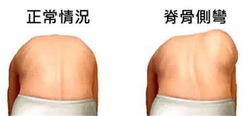 高低肩影响身体健康,千万别忽视!