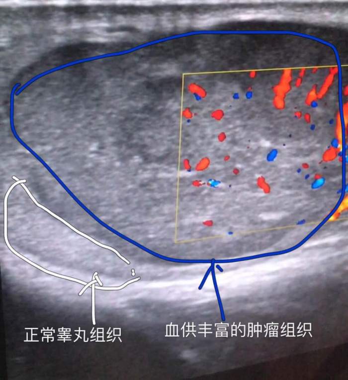 血供豐富的睪丸腫瘤