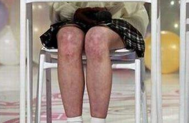 零下40度女大學生竟只穿短裙出門 雙腿發紫腫脹導致二級凍傷