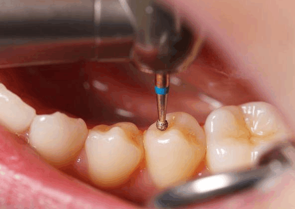 第一次洗牙是什么感受? 成年人到底有没有洗牙的必要?