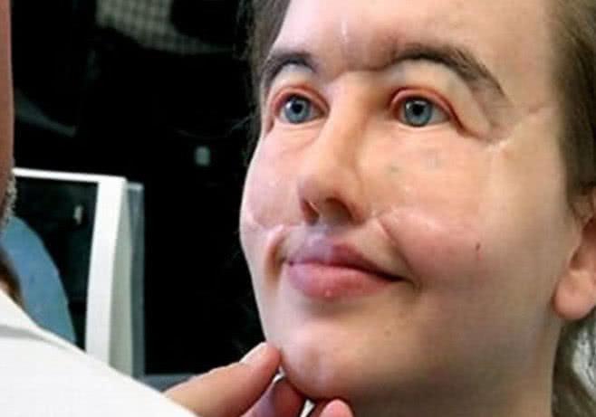 女子玩枪炸烂面部留下大坑, 为了不吓到孩子, 坚持每天戴面具!