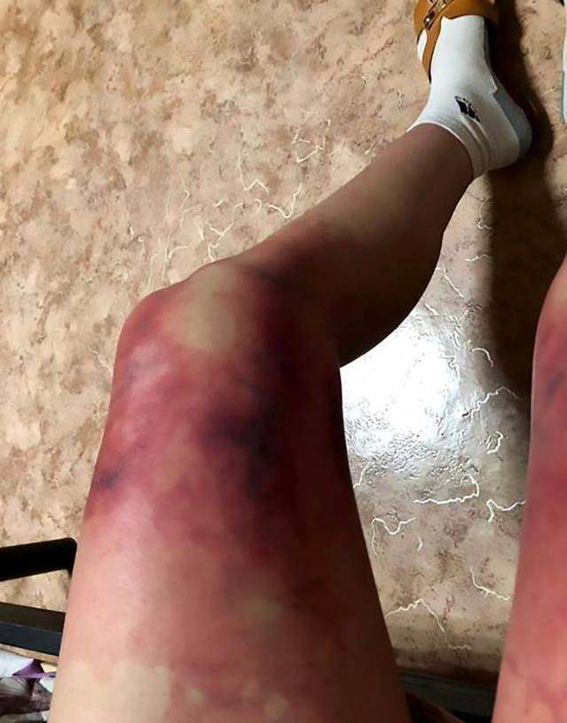 零下40度女大學生竟只穿短裙出門 雙腿發紫腫脹導致二級凍傷