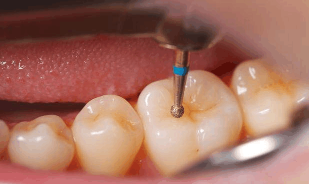 第一次洗牙是什么感受? 成年人到底有没有洗牙的必要?