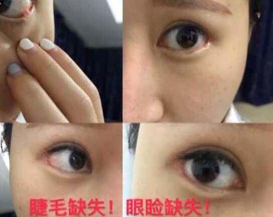 ?女子整容后下眼脸和眼球粘一起，险致盲，医院: 执刀医生已死亡