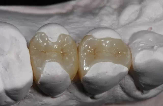 还得根管治疗,牙体脆性增强,套上牙冠是保护基牙,不然只是补牙,咀嚼时