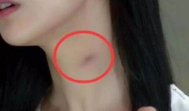 健身：肺癌“觉醒”的前兆，一旦脖子出现3个异常，或许体内有癌细胞了