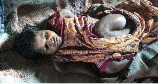 小女孩天生206枚骨头缺失, 身体柔软如水蛇, 村民: 天神的惩罚