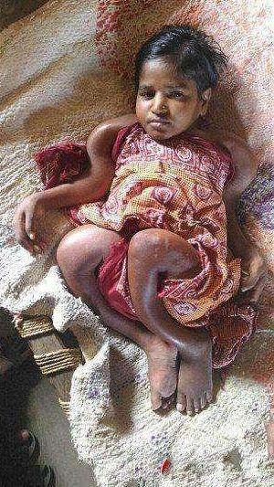 小女孩天生206枚骨头缺失, 身体柔软如水蛇, 村民: 天神的惩罚