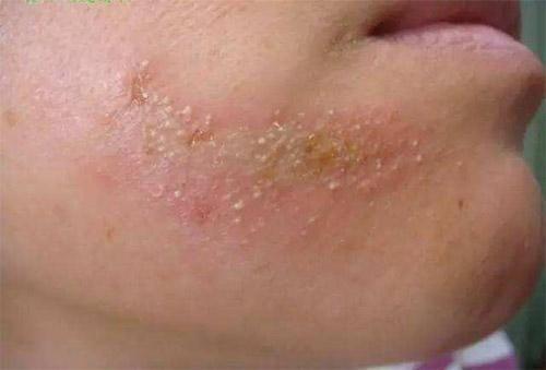 家里螨虫超级多？只需一根草，不到1毛钱，螨虫全部死光光