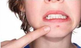 下巴上出现的“白色小颗粒”，是螨虫分泌物吗？可能很多人误解了