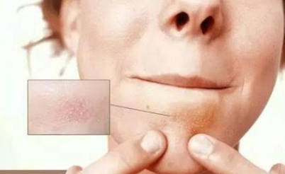 下巴上出现的“白色小颗粒”，是螨虫分泌物吗？可能很多人误解了