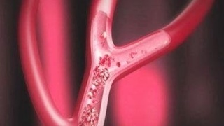 身体发出这3个信号是血栓“报道”的前兆，若不重视，身体将一步步走向灭亡！