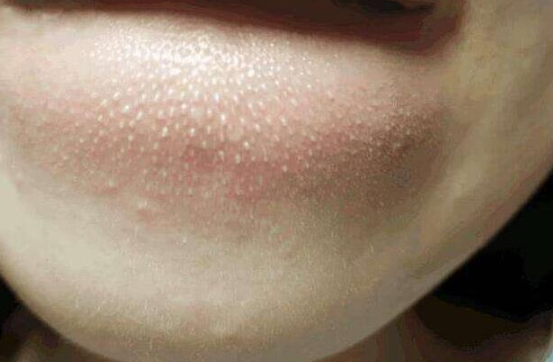 下巴上出现的“白色小颗粒”，是螨虫分泌物吗？可能很多人误解了