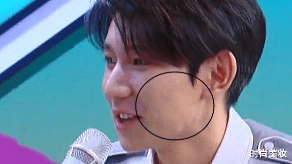 王源|王源脸上的痘痘越发严重, 从脸颊长到耳根, 快本的美颜都救不了