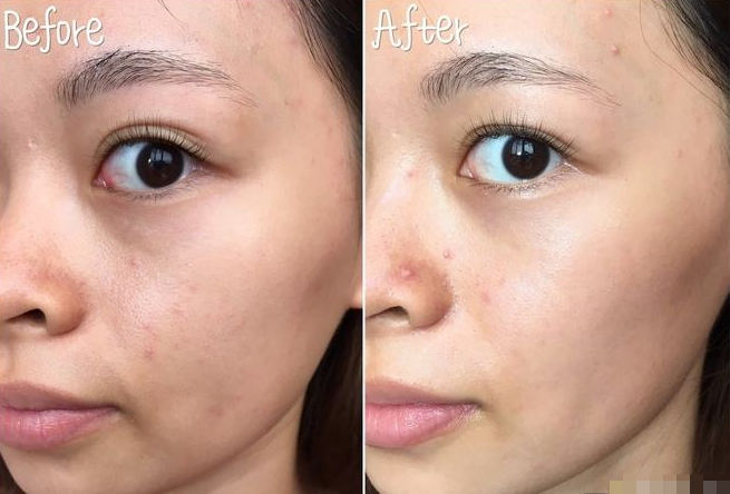 面膜|敷完面膜，脸上多余的“精华”真的要洗？还有人不听劝，难怪烂脸