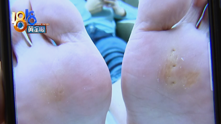 动次传媒 去除脚底肉刺,48块变480块?