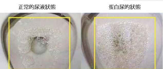 关节炎|肾不好的人，睡觉时有什么表现？