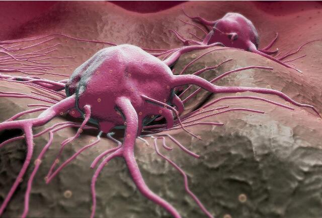 癌细胞|身体出现的3个“怪象”，可能是癌细胞正在敲门