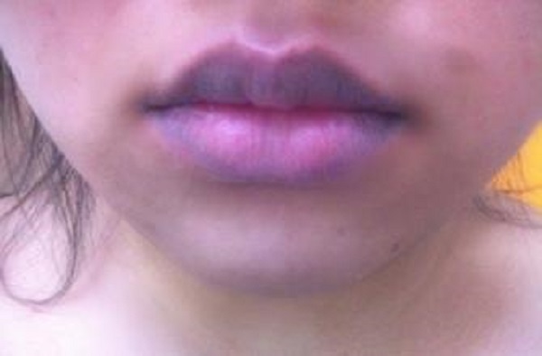 心脏病|心脏不好的人,脸上通常会有这4种表现,请留意一下