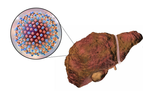 肝癌|提醒:身上4处反复“红痒”,可能是肝癌找上门,别单纯以为过敏